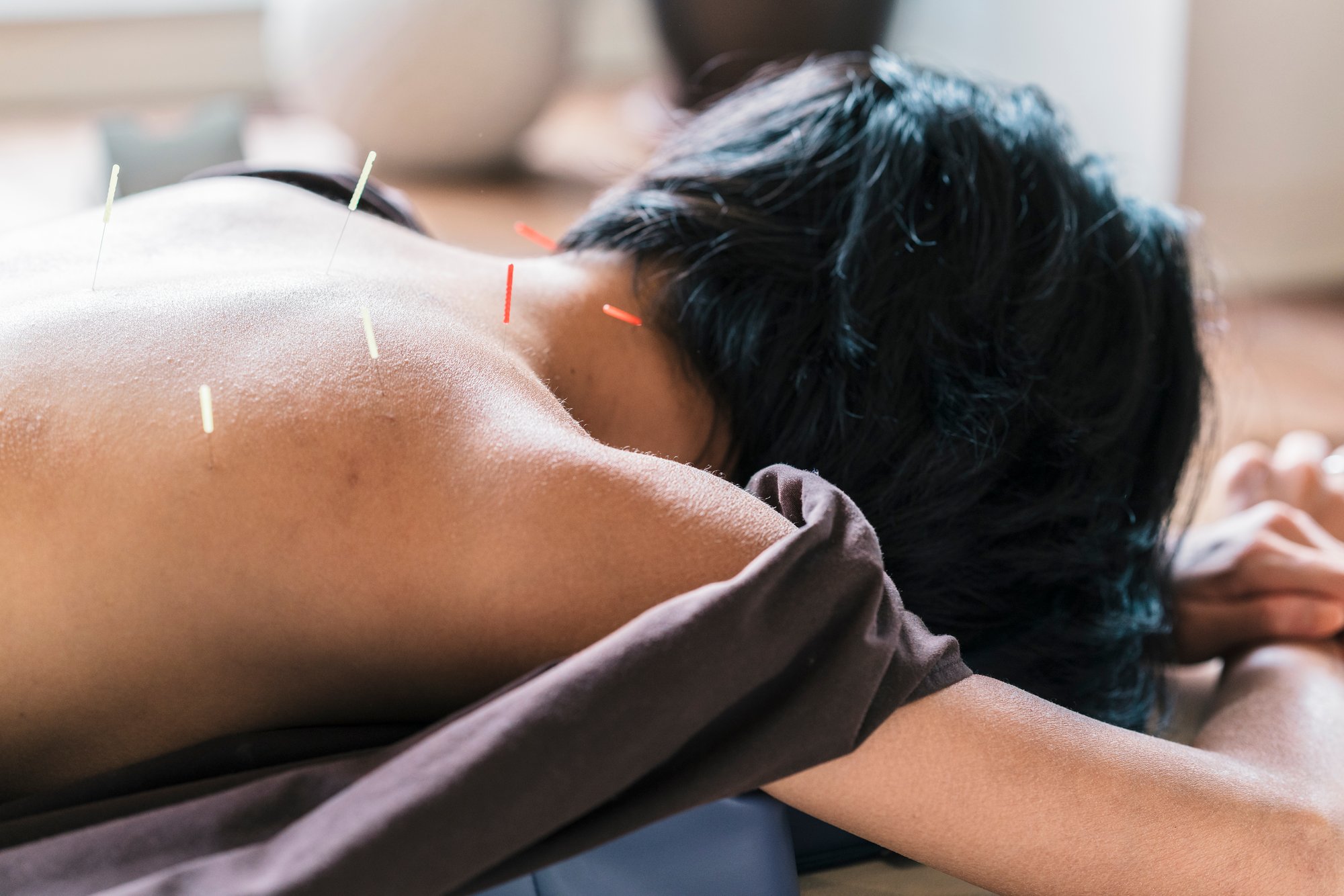 therapist-giving-cupping-treatment-to-young-asian-2024-09-13-16-53-24-utc