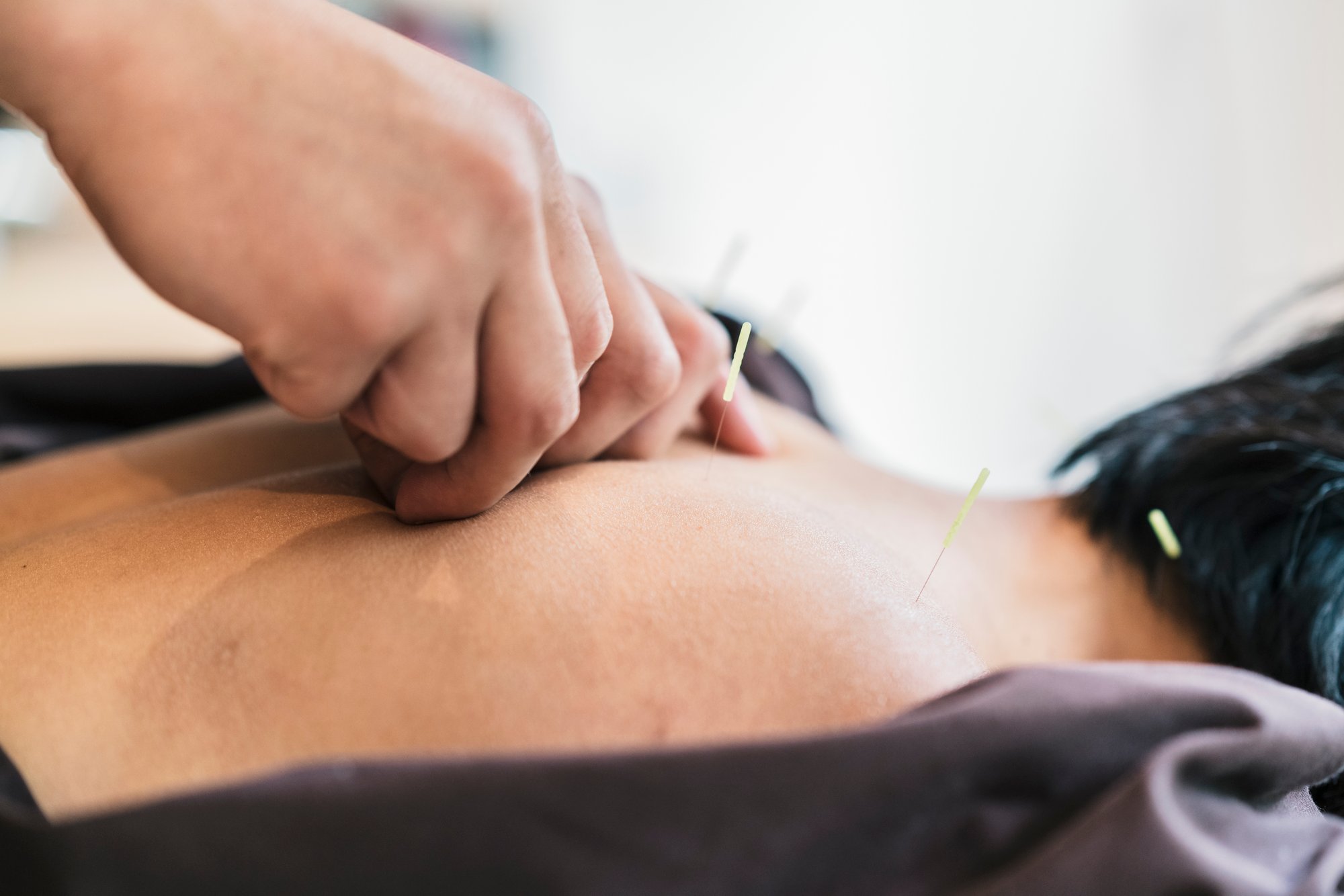 therapist-giving-cupping-treatment-to-young-asian-2024-09-16-09-06-54-utc