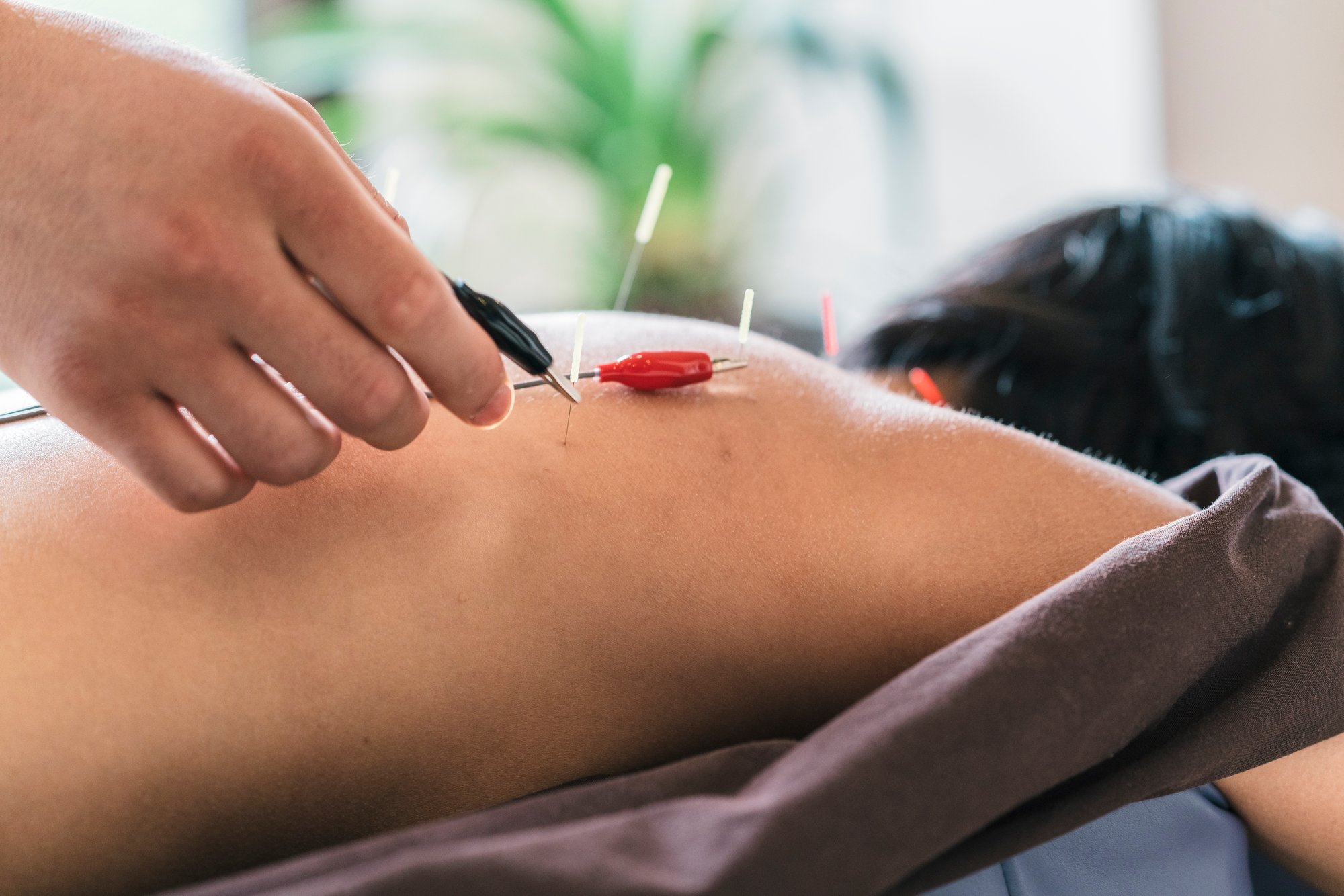 therapist-giving-cupping-treatment-to-young-asian-2024-09-22-06-29-46-utc
